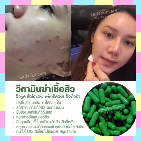 Enacycline วิตามินดูแลเรื่องสิวหน้าใส ลดสิว