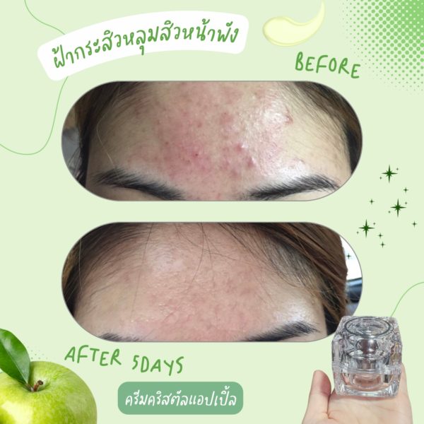 ✨Pro‼️ ครีมคริสตัลรกแอปเปิ้ลสเต็มเซลล์ ครีมพรีเมี่ยมสลายฝ้ากระ หน้าขาวใส รักษาผิวหน้าเร่งด่วน - Image 7