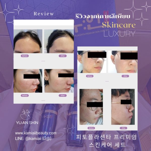 🇰🇷โปรด่วน1แถม1 🔥เซทสกินแคร์หรูคลินิกผิวเกาหลี + แถมเครื่องทรีทเม้นท์หน้าของคลินิก คืนชีพผิวไวมาก - Image 17