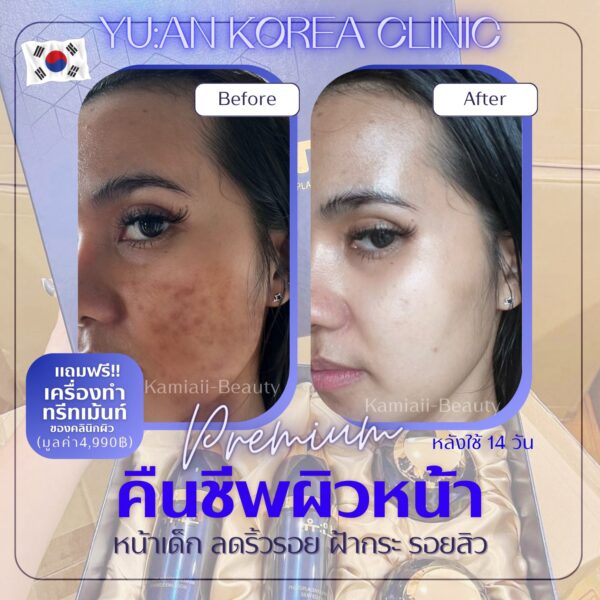 🇰🇷โปรด่วน1แถม1 🔥เซทสกินแคร์หรูคลินิกผิวเกาหลี + แถมเครื่องทรีทเม้นท์หน้าของคลินิก คืนชีพผิวไวมาก - Image 14
